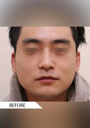 Before