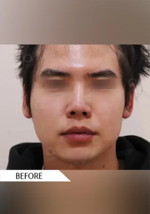 Before
