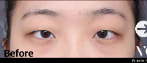 Before