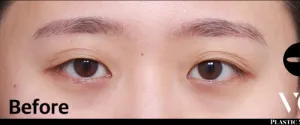Before