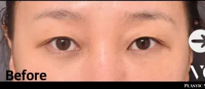 Before