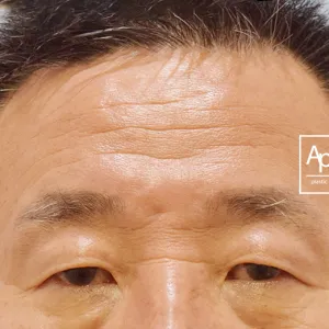 Before