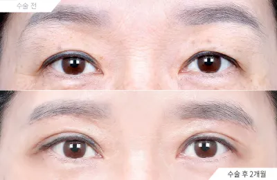 Before & After