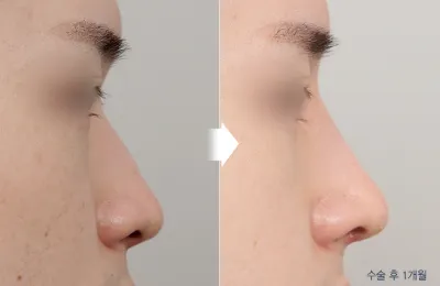 Before & After