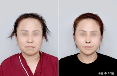 Before & After