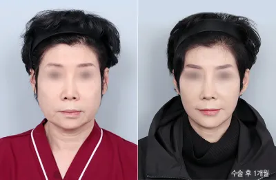 Before & After