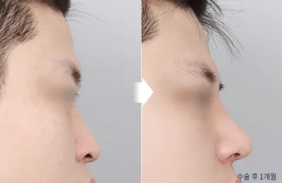 Before & After