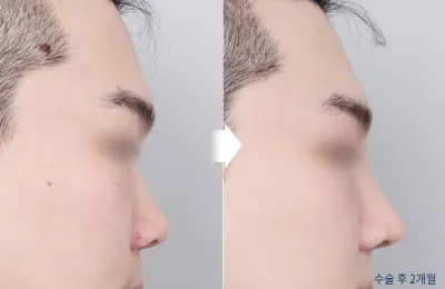 Before & After
