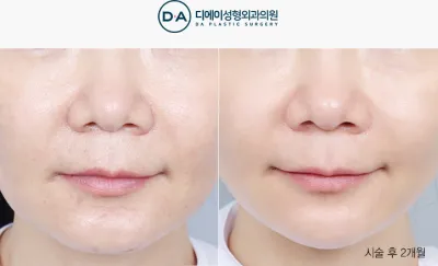 Before & After