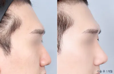Before & After