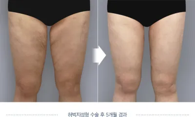 Before & After