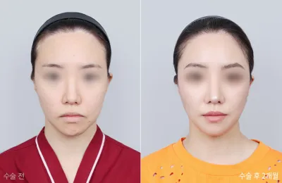 Before & After