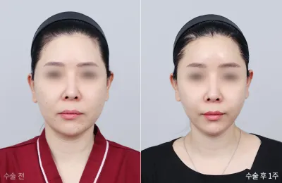 Before & After