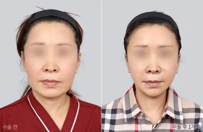 Before & After