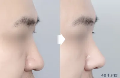 Before & After