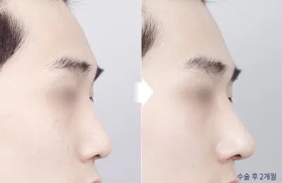 Before & After