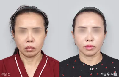 Before & After