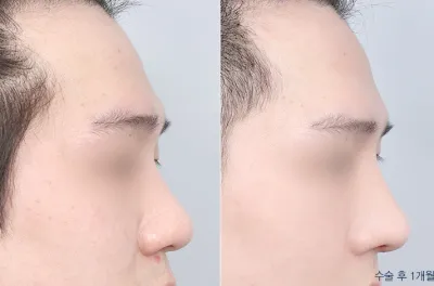 Before & After