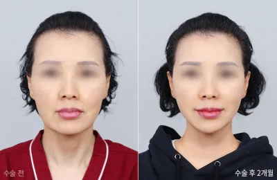 Before & After
