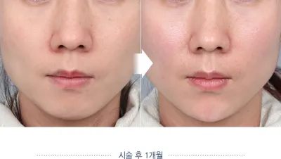 Before & After