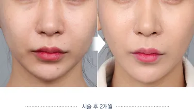 Before & After