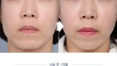 Before & After