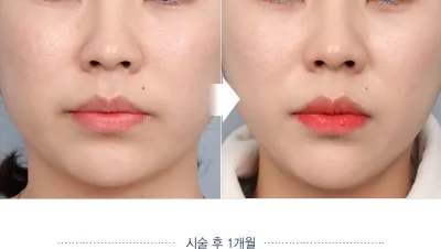 Before & After