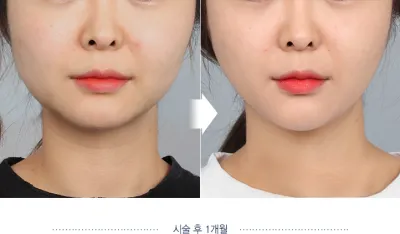 Before & After