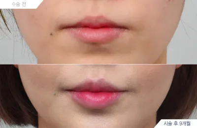 Before & After