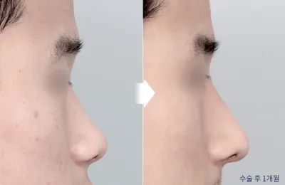 Before & After