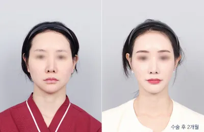 Before & After