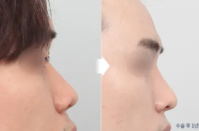 Before & After