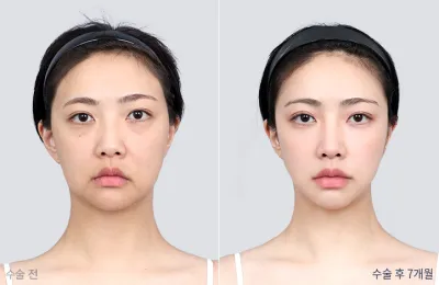 Before & After