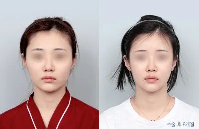 Before & After