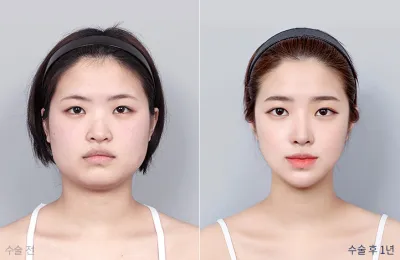 Before & After