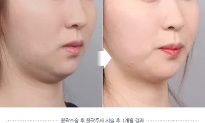 Before & After