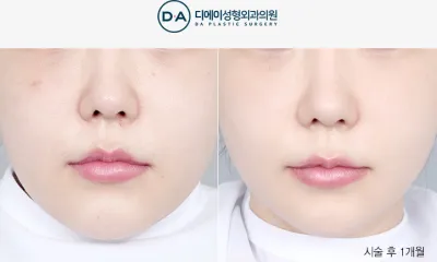 Before & After