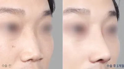 Before & After