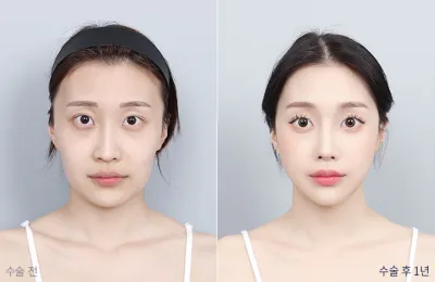 Before & After