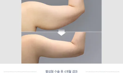 Before & After
