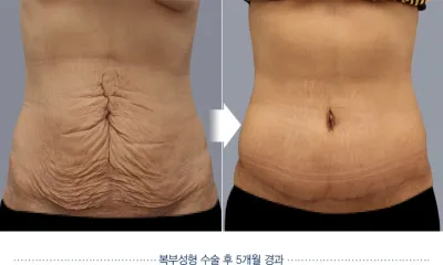 Before & After
