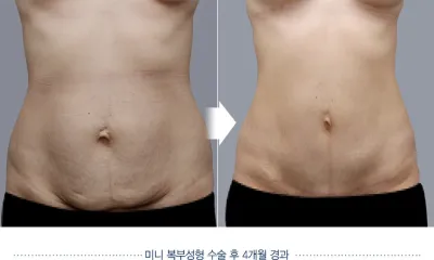 Before & After