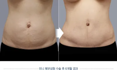 Before & After