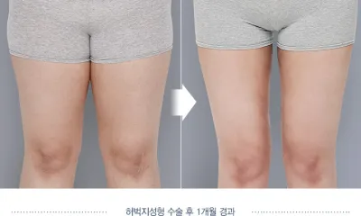 Before & After