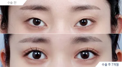 Before & After