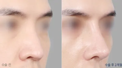 Before & After