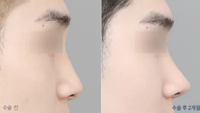 Before & After