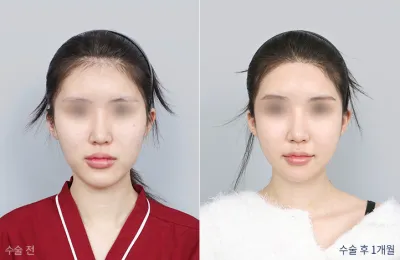 Before & After