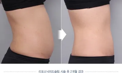Before & After