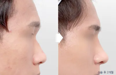 Before & After